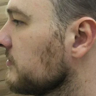 Patchy beard before using BeardForge