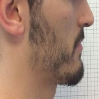 Thin beard before BeardForge program