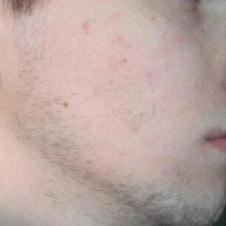 Sparse facial hair before app